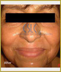 After-Infini Radiofrequency Microneedling