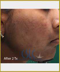 After-Infini Radiofrequency Microneedling