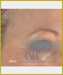 After-Infini Radiofrequency Microneedling
