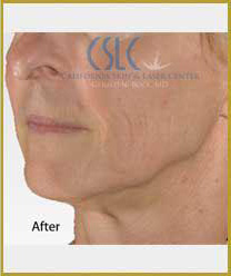 After-Infini Radiofrequency Microneedling