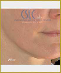 After-Infini Radiofrequency Microneedling
