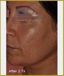 After-Infini Radiofrequency Microneedling