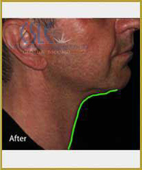 After-Infini Radiofrequency Microneedling