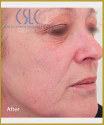 After-Infini Radiofrequency Microneedling