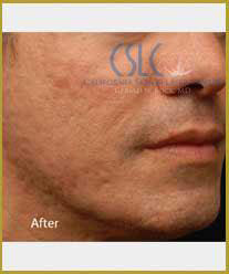 After-Infini Radiofrequency Microneedling