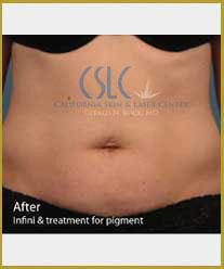 After-Infini Radiofrequency Microneedling