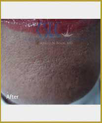 After-Infini Radiofrequency Microneedling