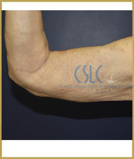 After - J-Plasty