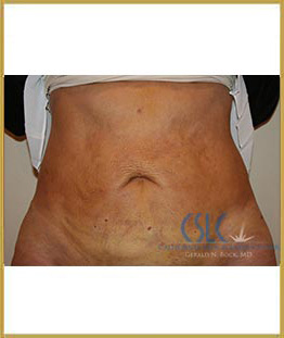 After - J-Plasty