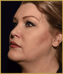 After - J-Plasty