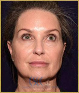 After - J-Plasty