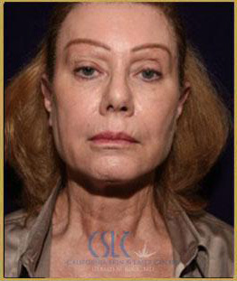 After - J-Plasty 