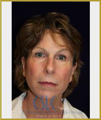 After - Sciton Laser Resurfacing