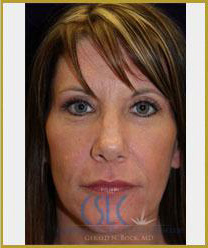 After - Sciton Laser Resurfacing