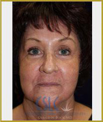 Before - Sciton Laser Resurfacing