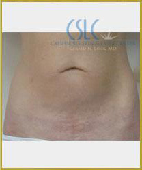 After - Sciton Laser Resurfacing