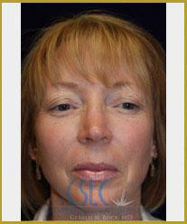 After - Microlaserpeel and BroadBand Light