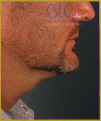 Before - Treatments For Men