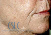 Before - Sculptra Treatment