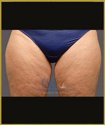 Before - CoolSculpting Inner Thighs