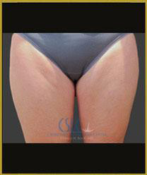 Before - CoolSculpting Inner Thighs