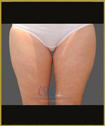 Before - CoolSculpting Inner Thighs