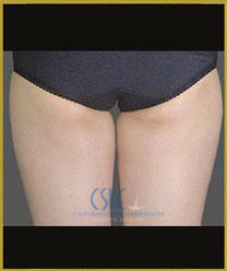 Before - CoolSculpting Inner Thighs