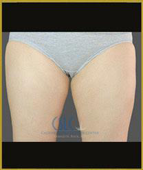 Before - CoolSculpting Inner Thighs