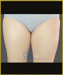 Before - CoolSculpting Inner Thighs