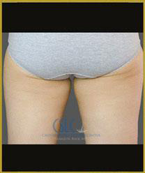 Before - CoolSculpting Inner Thighs