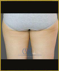Before - CoolSculpting Inner Thighs