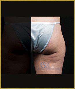 Before - CoolSculpting Outer Thighs