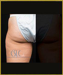 Before - CoolSculpting Outer Thighs