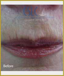 Before-Infini Radiofrequency Microneedling