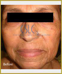 Before-Infini Radiofrequency Microneedling