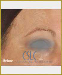 Before-Infini Radiofrequency Microneedling