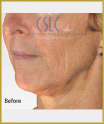 Before-Infini Radiofrequency Microneedling