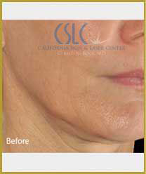 Before-Infini Radiofrequency Microneedling