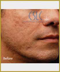 Before-Infini Radiofrequency Microneedling