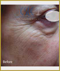 Before-Infini Radiofrequency Microneedling