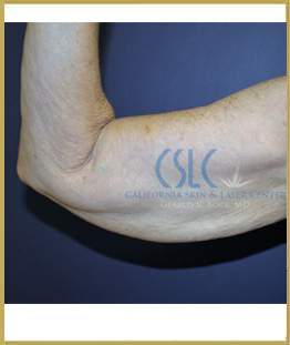 Before - J-Plasty