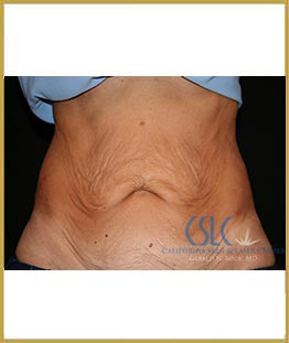 Before - J-Plasty