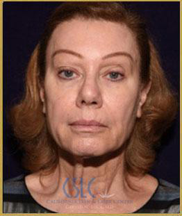  Before - J-Plasty 