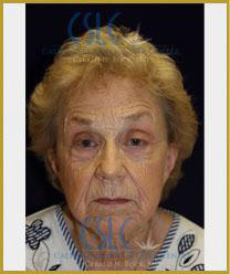 Before - Sciton Laser Resurfacing