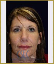 Before - Sciton Laser Resurfacing