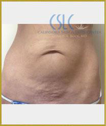 Before - Sciton Laser Resurfacing