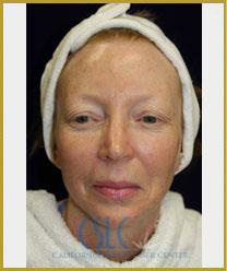 Before - Microlaserpeel and BroadBand Light