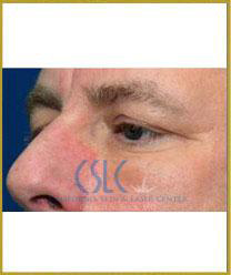 Before - Thermi Smooth