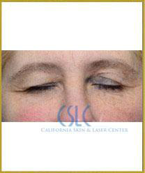 Before - Thermi Smooth