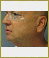 Before - Treatments For Men